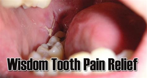 Home Remedies To Get Wisdom Teeth Pain Relief Yabibo