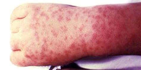 What Is Rocky Mountain Spotted Fever Signs Symptoms And Treatment For