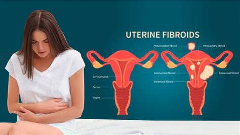 What Is Uterine Fibroids When Should You See A Doctor All You Need To Hot Sex Picture