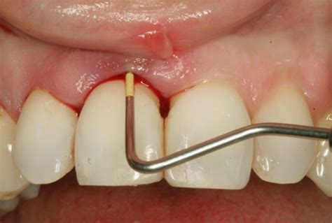 Infected Tooth Extraction Symptoms Treatment Causes Pictures