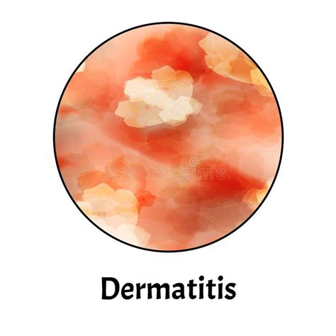 Inflammation De La Peau Peau De Dermatite Infographics Illustration