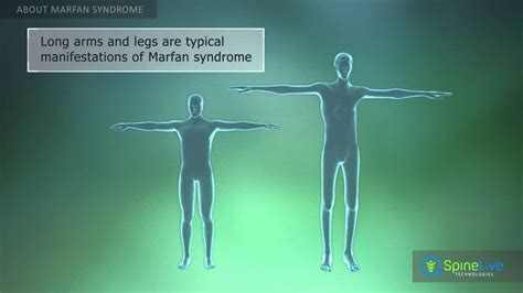Marfan Syndrome About Marfan Syndrome Genetic Disorders Medical Problems