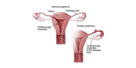 Ectopic Pregnancy Treatment And Surgery Hospital In India Rg Hospital