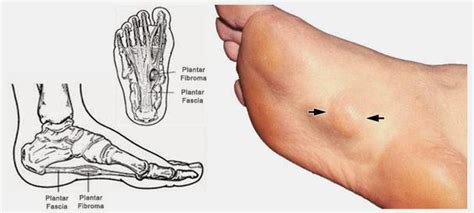 What Is Plantar Fibromatosis Mass4d® Foot Orthotics Art
