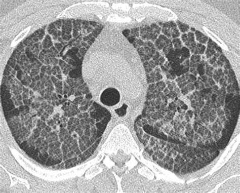 Pulmonary Alveolar Proteinosis Radiographics