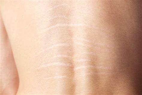 Top 7 Myths About Stretch Marks Debunked What To Know