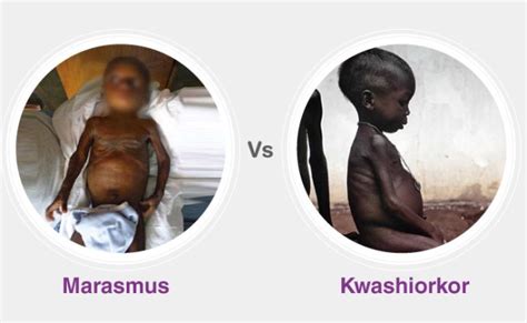 Ppp Kwashiorkor Marasmus Malnutrition Diseases And Disorders Otosection