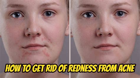 How To Get Rid Of Redness From Acne Fast Overnight Youtube