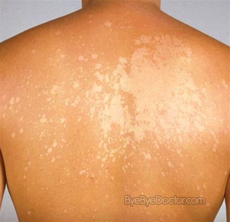 46 White Spots On Skin  Besteye