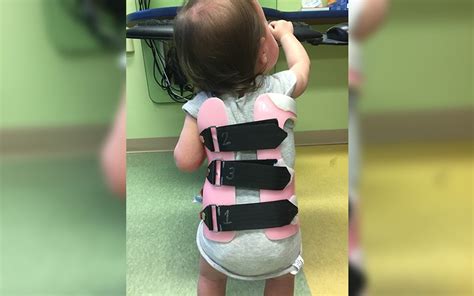 Infantile Scoliosis Treatment For Kelsey Through Bracing