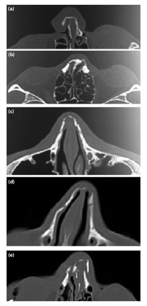 Foramina, nasal cavity, paranasal sinuses. Preoperative computed tomographic (CT) images of nasal ...