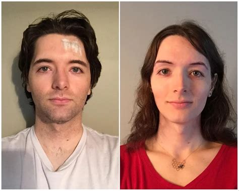 Transgender Surgery Female To Male Pictures Before And After