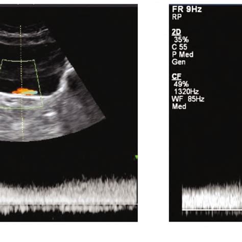 Normal Ureteric Jets By Color Doppler Flow Mapping In Transverse Scans Download Scientific