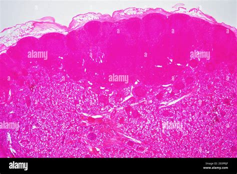 Lymph Nodule Hi Res Stock Photography And Images Alamy