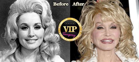 Dolly Parton Plastic Surgery Surgery Vip