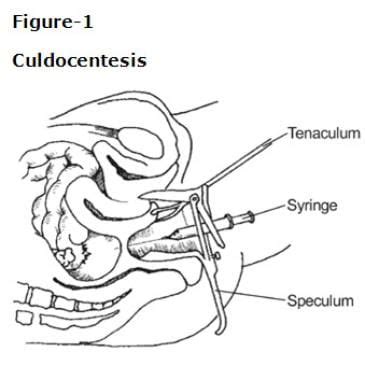 Culdocentesis Overview Indications Contraindications