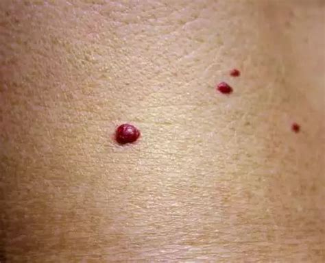 Red Spots On Skin Skin Spots Red Skin Spots Cherry Angioma