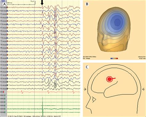 Reflex Seizures Traits And Epilepsies From Physiology To Pathology