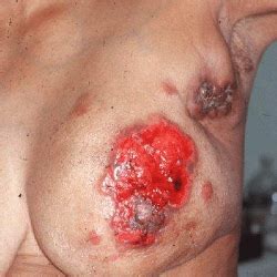 Breast cancer metastasis to the bones, brain or liver is most common, but it can spread anywhere in the body. Symptoms And Complications Of Metastatic Breast Cancer ...