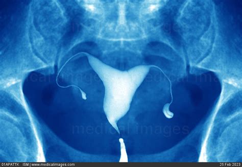 Stock Image Hysterosalpingogram Of The Normal Uterus Fallopian Tubes