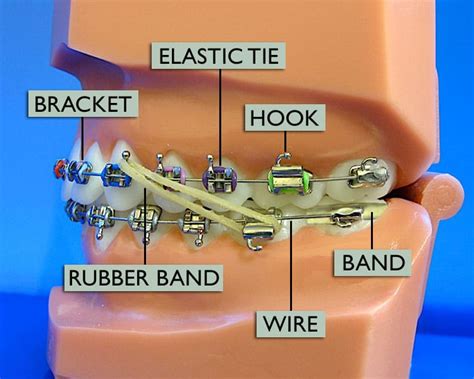 Braces Diagram Wright Orthodontics Atlanta Marietta Ga