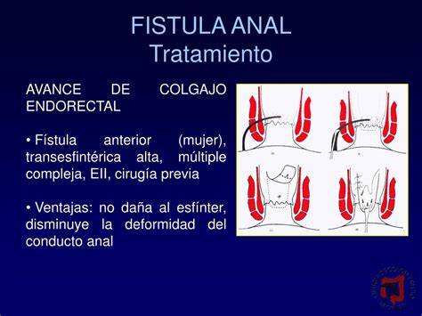 Ppt Conceptos Actuales En El Tratamiento De La Fistula Anal