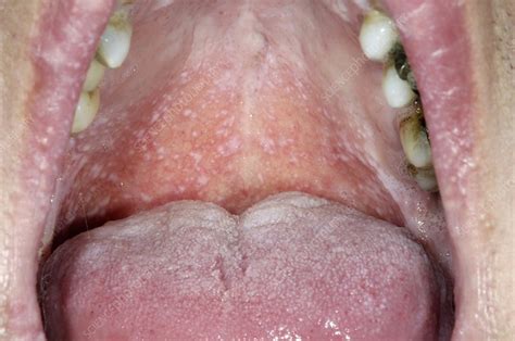 Oral Lichen Planus Disease Stock Image M2000270 Science Photo Library