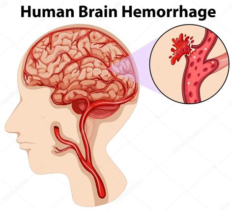 Diagrama Que Muestra Hemorragia Cerebral Humana Sexiz Pix