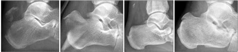 Classification Of Avulsion Fracture Of The Calcaneal Tuberosity Type
