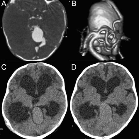 A An Axial Brain Contrast Enhanced Computed Tomography Image