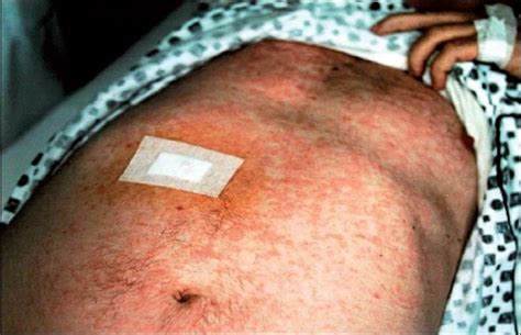 Angioimmunoblastic T Cell Lymphoma Skin Rash Cutaneous T Cell