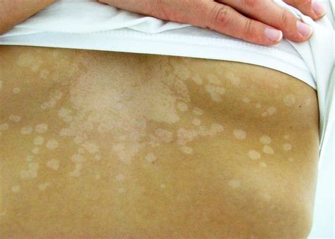 What Is The Difference Between Pityriasis Alba And Tinea Versicolor