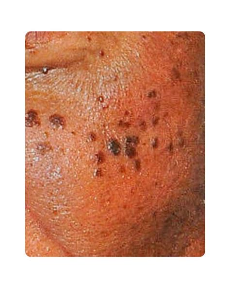 Yess Huidtherapie Dermatosis Papulosa Nigra
