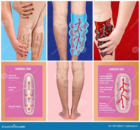 Varicose Veins On A Female Senior Legs The Structure Of Normal And Varicose Veins Stock