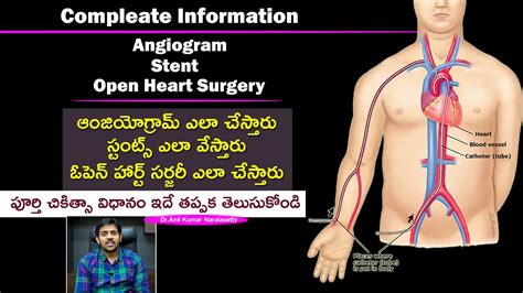 angiogram stent open heart surgery treatment process clearly explained dr anil kumar