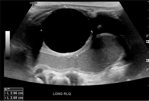 Abdominal Ultrasound With 3 × 3cm Cystic Structure In The Right Lower