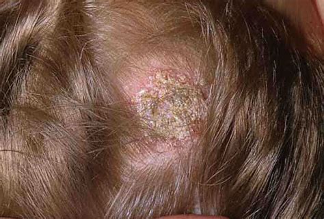 Ringworm Of Scalp Picture Hardin Md Super Site Sample