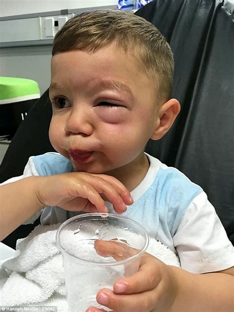 Boys Face Is Left Swollen After He Suffers Severe Allergic Reaction