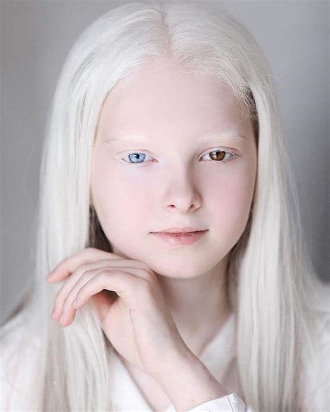 Retratos Et Reos Destacam A Beleza Nica De Uma Menina Com Albinismo E Heterocromia