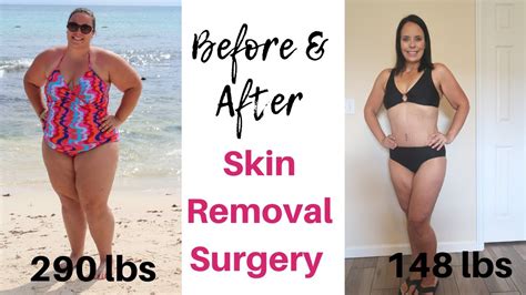 Before After Skin Removal Surgery After Vsg Gastric Sleeve Surgery Lb Weight Loss Youtube