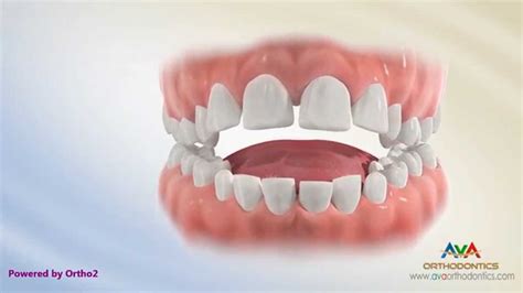 Orthodontic Treatment For Tongue Thrusting Habit Different Options Youtube