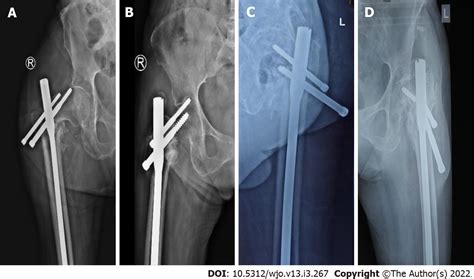 Comparative Study Of Intertrochanteric Fracture Fixation Using Proximal