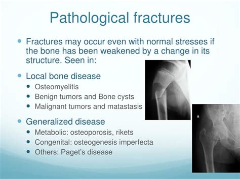 Ppt Principles Of Fractures And Fracture Management Powerpoint