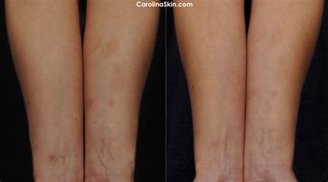Scar Treatment Charlotte Dermatology Laser Vein Specialists