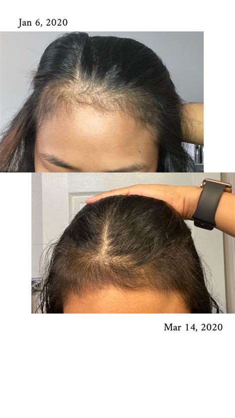 Diffuse Hair Loss Alopecia Causes Signs And Treatments Artofit