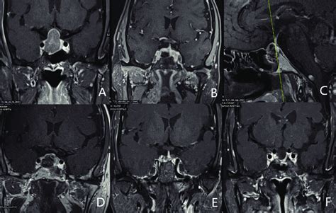 A Preoperative Magnetic Resonance Imaging Mri Showing Wilson Grade