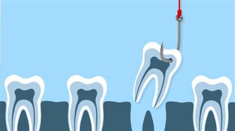 Die schmerzen können vor dem entfernen durch das lockern des zahns und. Zahn ziehen: Gründe, Vor- und Nachteile - NetDoktor.de