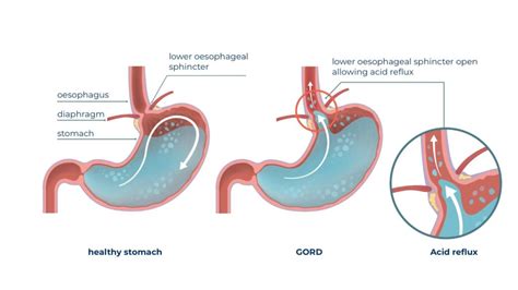 Reflux Surgery Hiatus Hernia Perth Reflux Surgeons