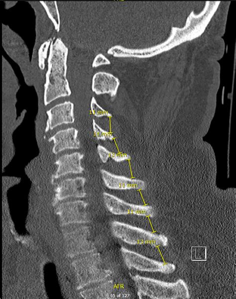 Ct Scan Image Of Cervical Spine D Image With Coronal Vrogue Co