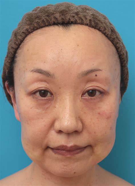 頬がたるんでいる50代女性に小顔専用高濃度脂肪溶解メソカクテルを行った症例の経過画像です。 美容整形高須クリニック 高須 幹弥 オフィシャルブログ